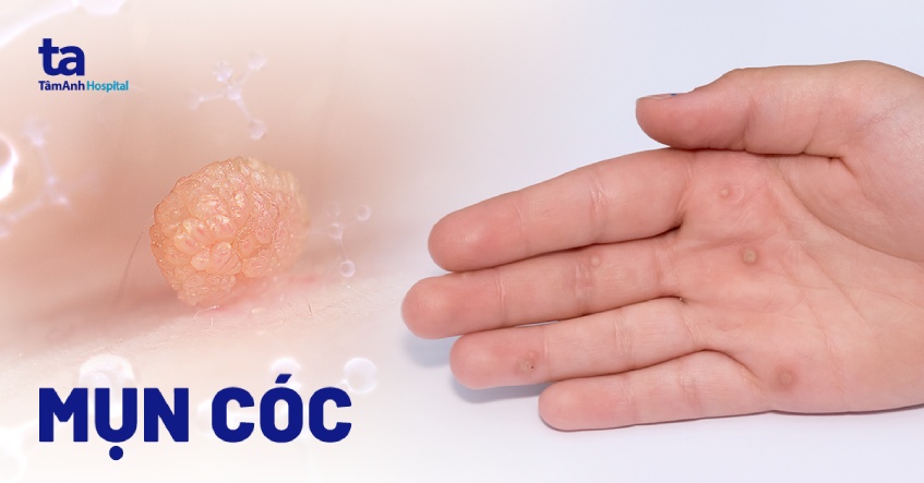 Mụn cóc là gì? Các loại mụn cóc - Nguyên nhân - Cách điều trị