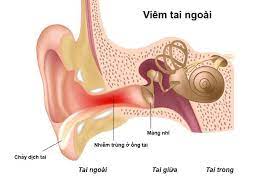 7 cách chữa viêm tai ngoài tại nhà hay và dễ áp dụng, bạn đã thử chưa?
