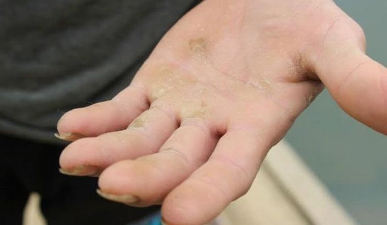Cách loại bỏ vết chai bàn tay và bàn chân cực hiệu quả