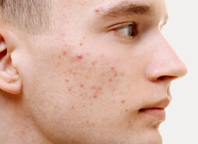 Ăn gì để giảm mụn trứng cá?