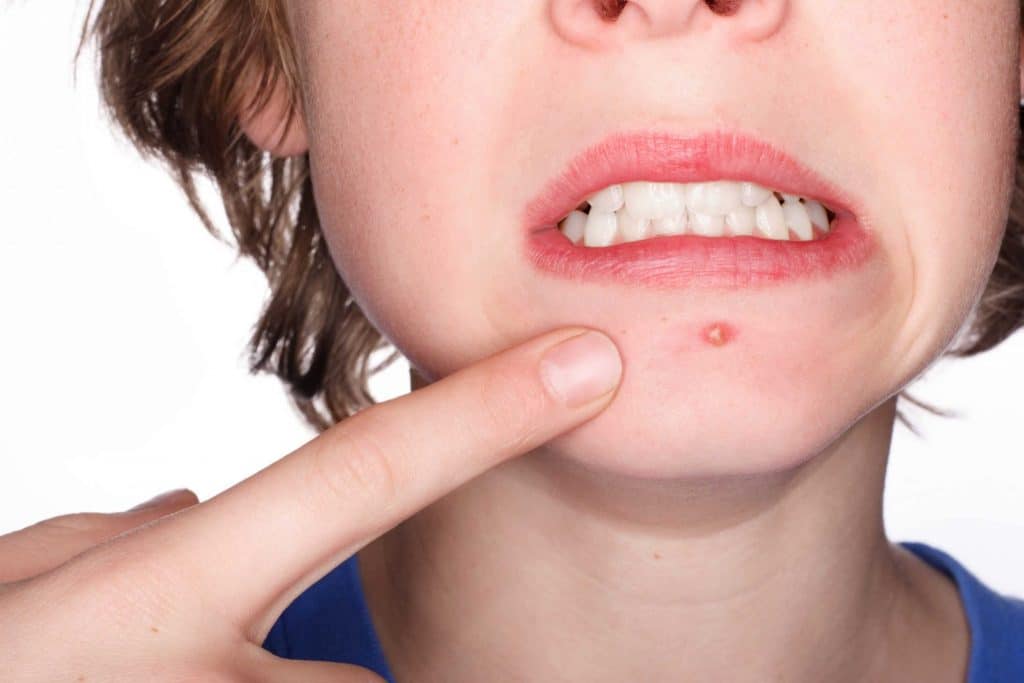 Bí quyết nặn mụn đúng cách