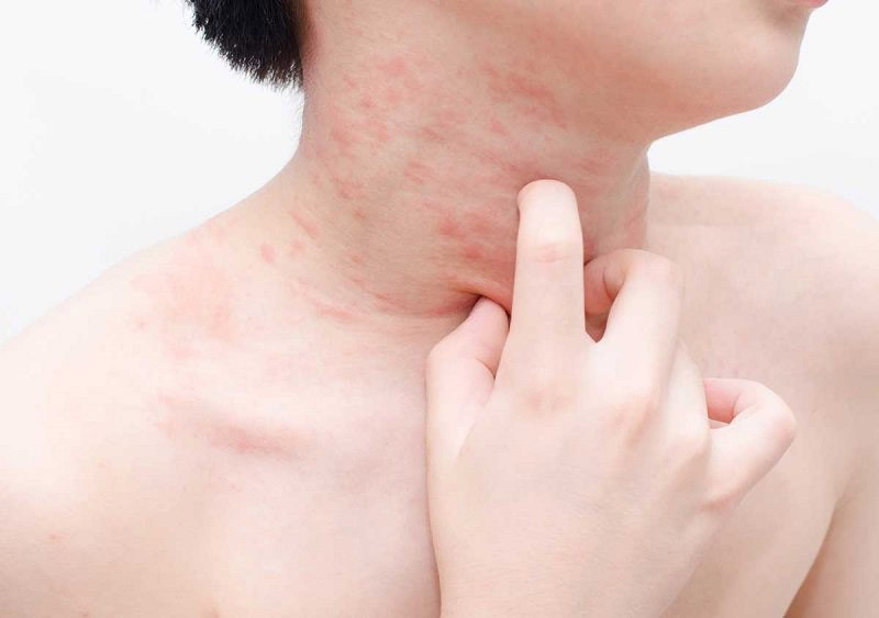 Người bị dị ứng với các loại quả thuộc họ bầu bí nên hạn chế ăn dưa lưới