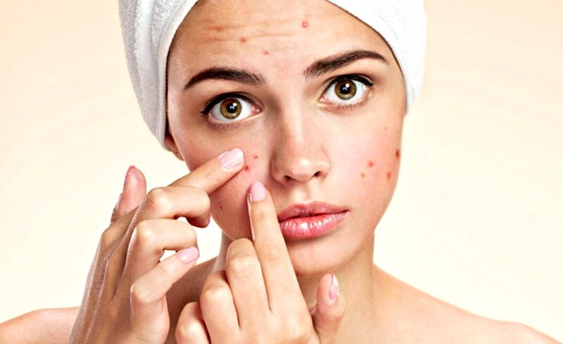 ĐIỀU TRỊ MỤN HIỆU QUẢ VÀ AN TOÀN