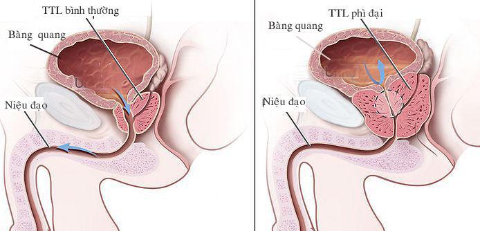 TRIỆU CHỨNG TIỀN LIỆT TUYẾN, PHƯƠNG PHÁP CHẨN ĐOÁN, LỐI SỐNG ẢNH HƯỞNG NHƯ THẾ NÀO?