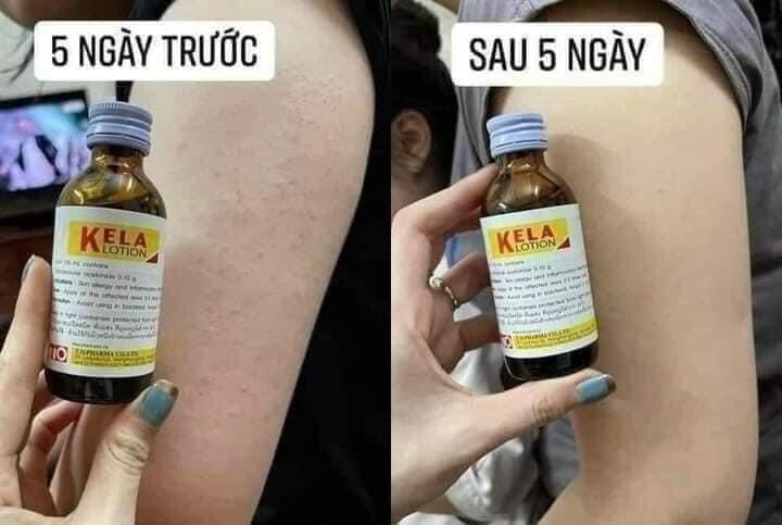[TL]Kem Kela Lotion Đặc Trị Viêm Da, Viêm Nang Lông 30ml