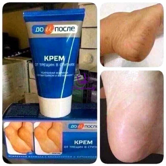 [Nga]Kem Giảm, Ngăn Ngừa Nứt Gót Chân Kpem Apteka Chính Hãng 50ml