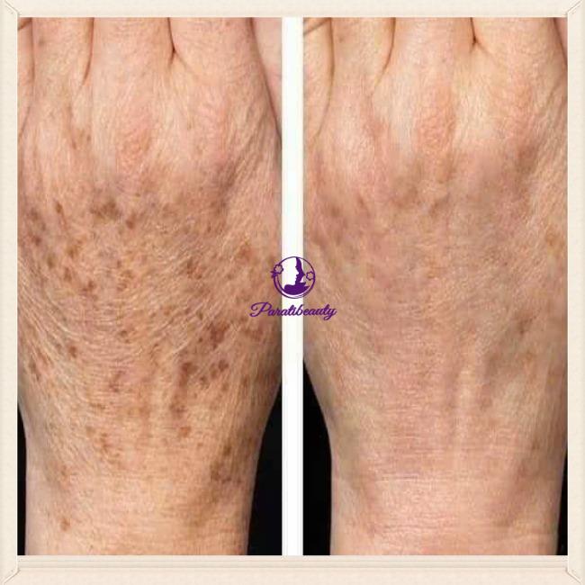 14.10 Kem Trị Nứt Nẻ Gót Chân, Ngón Tay Shishedo Urea 10% Cream Nhật Bản