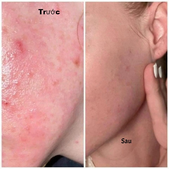 Toner Dành Cho Da Dầu, Mụn SVR Sebiaclear Micro Peel 150ml G