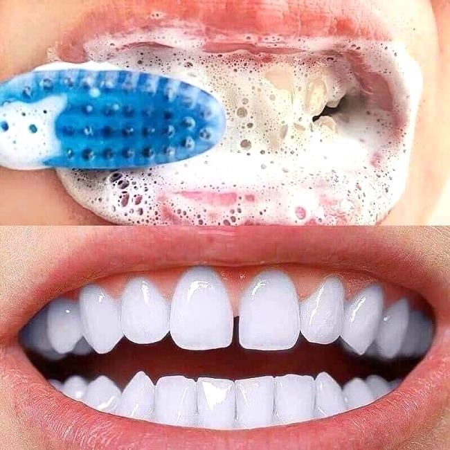 Kem Đánh Răng Tẩy Vôi Răng Chuyên Nghiệp MEDIAN Dental IQ Tartar Protection Toothpaste 120g