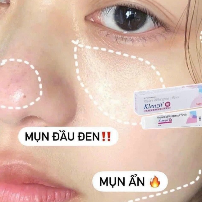 [Ấn Độ]Gel Trị Mụn Klenzit MS Aqueous Gel Mụn Ẩn, Mụn Viêm, Mụn Đầu Đen 15g