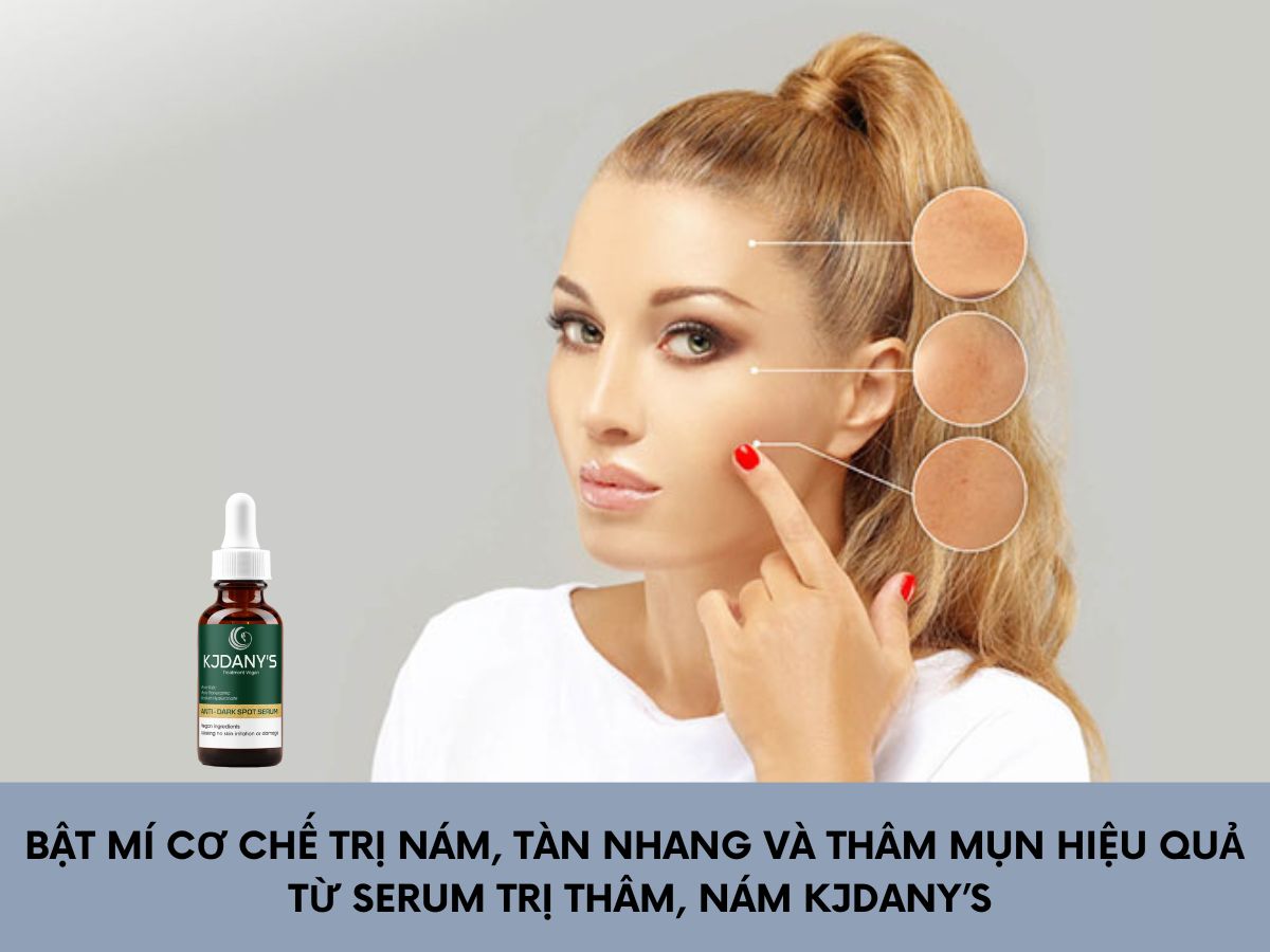 BẬT MÍ CƠ CHẾ TRỊ NÁM, TÀN NHANG VÀ THÂM MỤN HIỆU QUẢ - CHỈ SAU 5 NGÀY SỬ DỤNG SERUM TRỊ THÂM, NÁM KJDANY’S