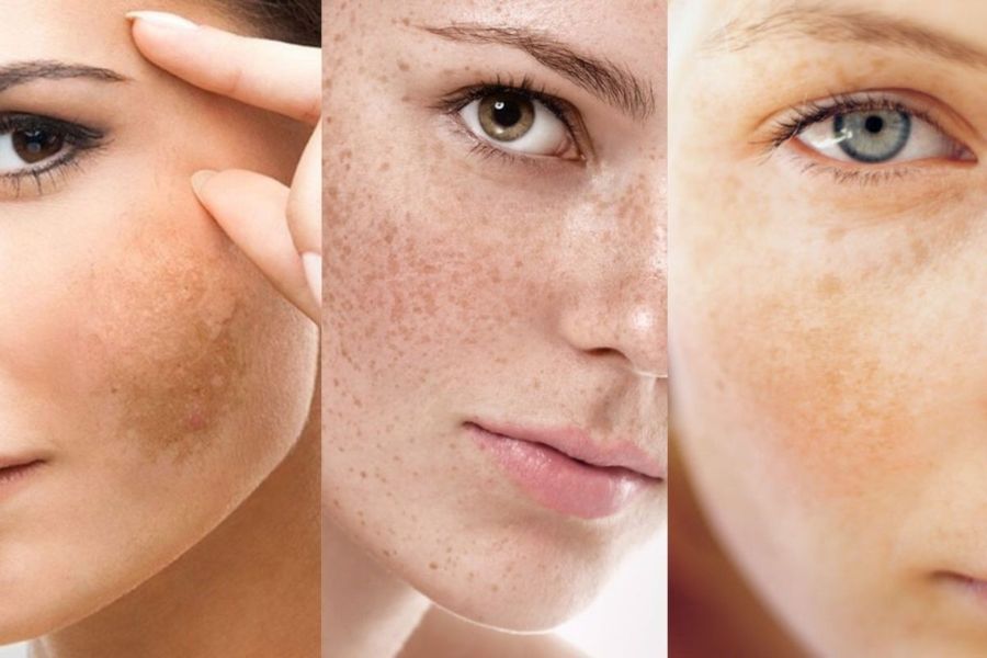 Nám, tàn nhang là tình trạng thường gặp phải hiện nay