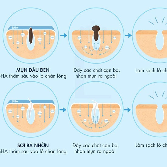 Tẩy Da Chết Hóa Học Obagi Clenziderm MD Pore Therapy BHA 2%