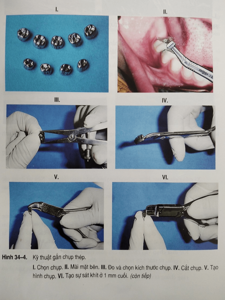 Chụp răng thép có sẵn cho trẻ em: Các bước sửa soạn và đặt chụp