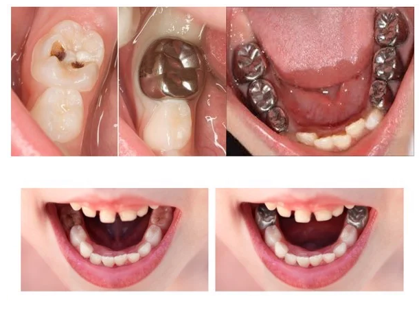 Ưu điểm của chụp thép có sẵn và các nguyên tắc khi sử dụng chụp thép trẻ em