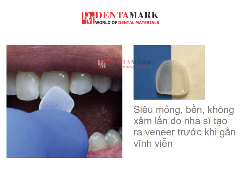 Veneer không mài răng - Kỹ thuật dán răng thẩm mỹ hiện đại