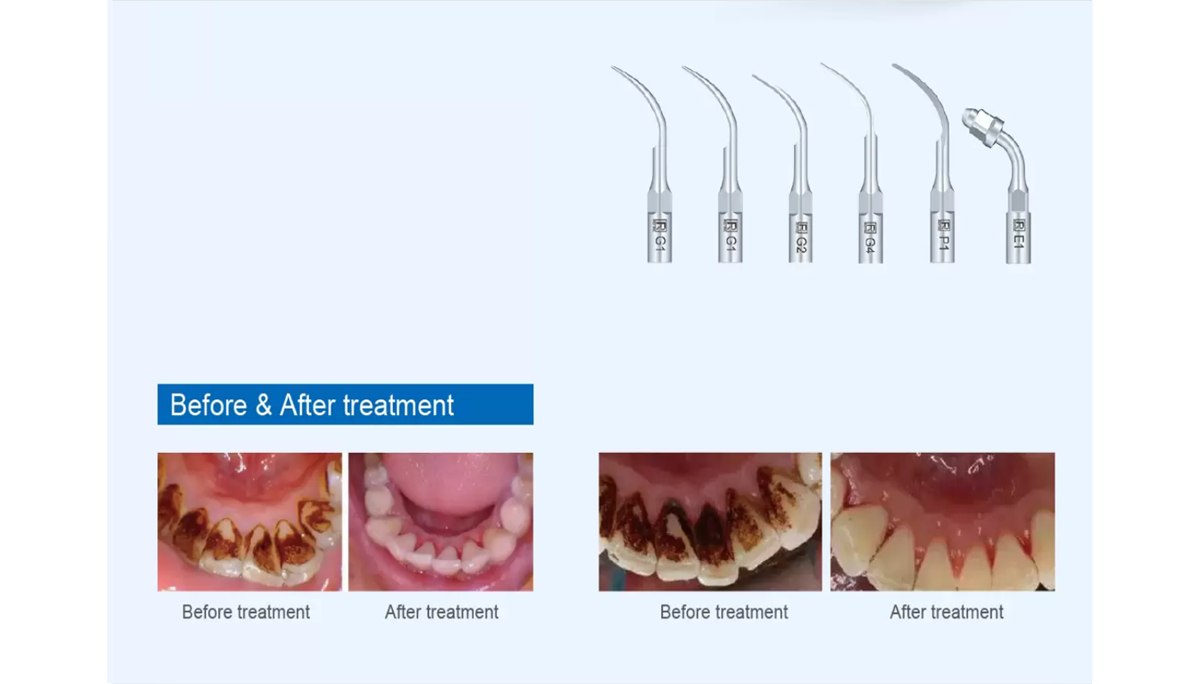 Bộ đầu tip máy cạo vôi răng MaxPiezo 7+ REFINE.