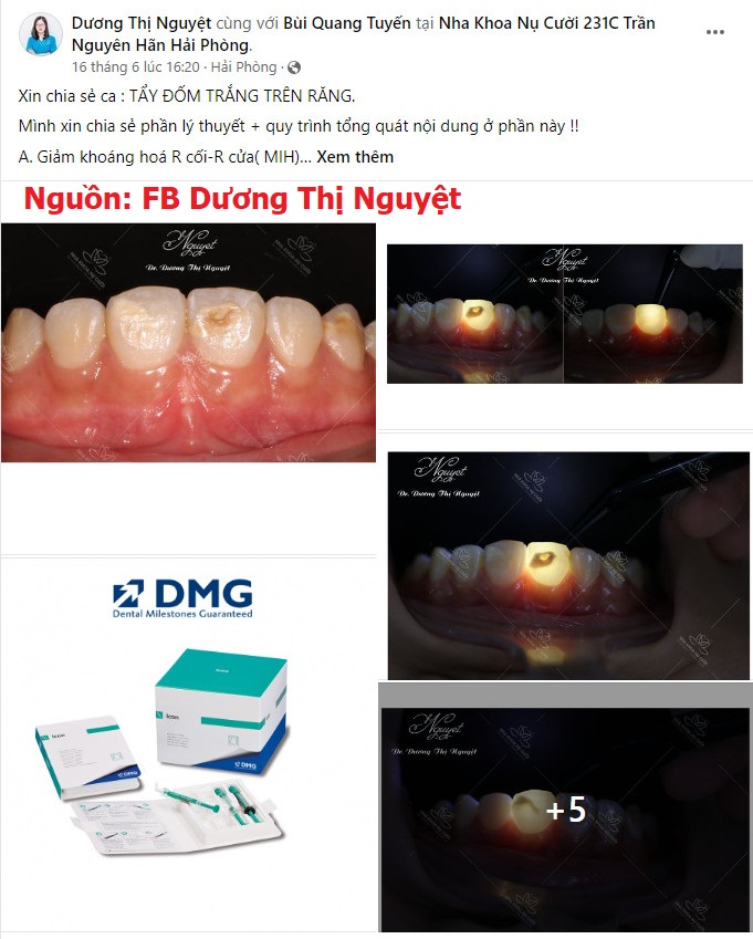  Case lam sang, hieu qua Dieu tri dom trang bang icon smooth surface DMG, tay dom trang icon, xu ly dom trang icon, loai bo dom trang icon DMG, Icon DMG chinh hang, Icon DMG uu dai (1)