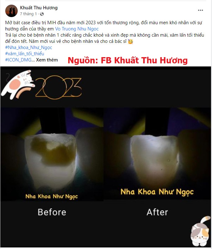  Case lam sang, hieu qua Dieu tri dom trang bang icon smooth surface DMG, tay dom trang icon, xu ly dom trang icon, loai bo dom trang icon DMG, Icon DMG chinh hang, Icon DMG uu dai (1)