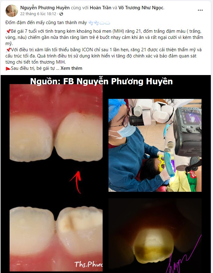  Case lam sang, hieu qua Dieu tri dom trang bang icon smooth surface DMG, tay dom trang icon, xu ly dom trang icon, loai bo dom trang icon DMG, Icon DMG chinh hang, Icon DMG uu dai (1)