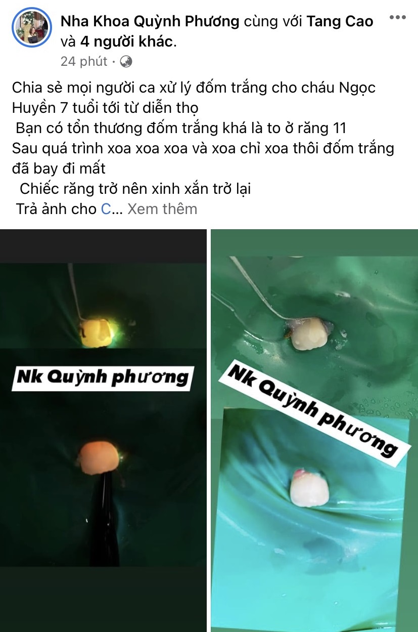  Case lam sang, hieu qua Dieu tri dom trang bang icon smooth surface DMG, tay dom trang icon, xu ly dom trang icon, loai bo dom trang icon DMG, Icon DMG chinh hang, Icon DMG uu dai (1)