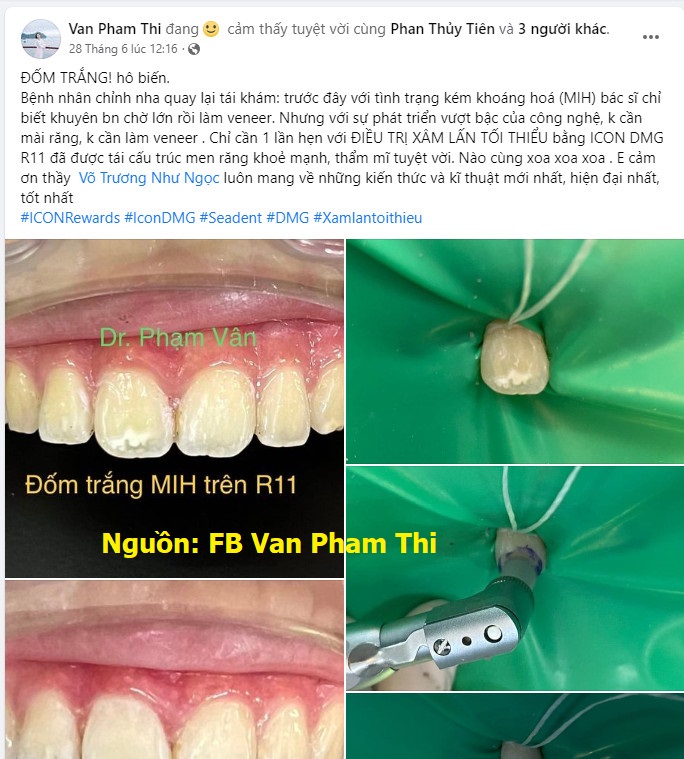  Case lam sang, hieu qua Dieu tri dom trang bang icon smooth surface DMG, tay dom trang icon, xu ly dom trang icon, loai bo dom trang icon DMG, Icon DMG chinh hang, Icon DMG uu dai (1)