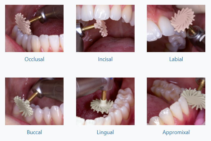 Mũi đánh bóng composite EVE Diacomp Plus Twist trên bề mặt răng