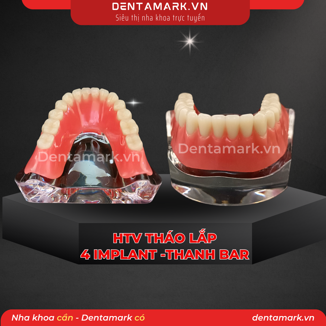 1Mau ham tu van nha khoa, ham tu van benh nhan, ham tu van thao lap, ham tu van implant, ham tu van thao lap 4 implant, phuc hinh thao lap 4 implant, ham Implant all on 4