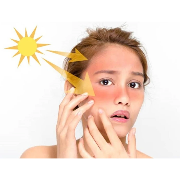 Nguyên nhân gây nám da và cách phòng ngừa