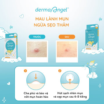 Miếng Dán Mụn Derma Angel Dùng Cho Ngày & Đêm 18 Miếng Acne Patch For Day & Night MB Beauty