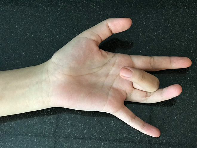 Ngón tay lò xo (ngón tay cò súng): những điều cần biết