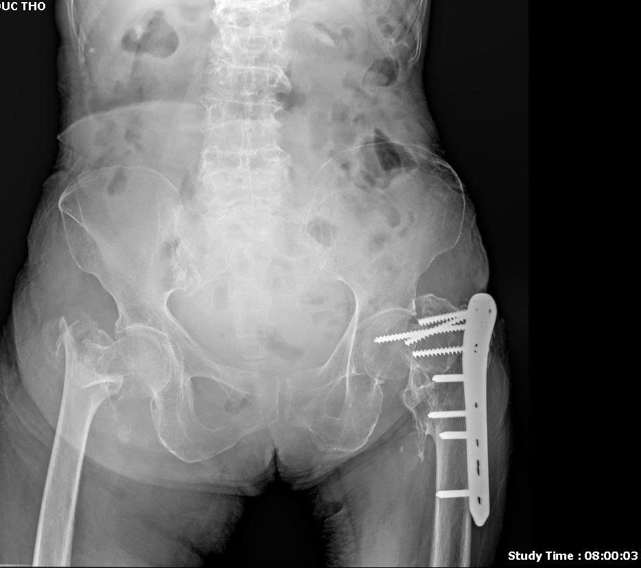 Loãng xương ở người cao tuổi - chỉ một cú ngã cũng có thể gãy cổ xương đùi