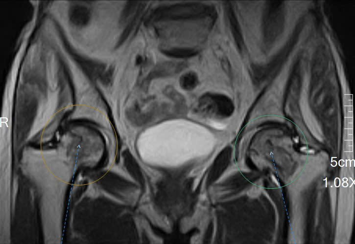 Một lần chụp MRI - Phát hiện sớm hoại tử chỏm xương đùi, tránh nguy cơ phải thay khớp
