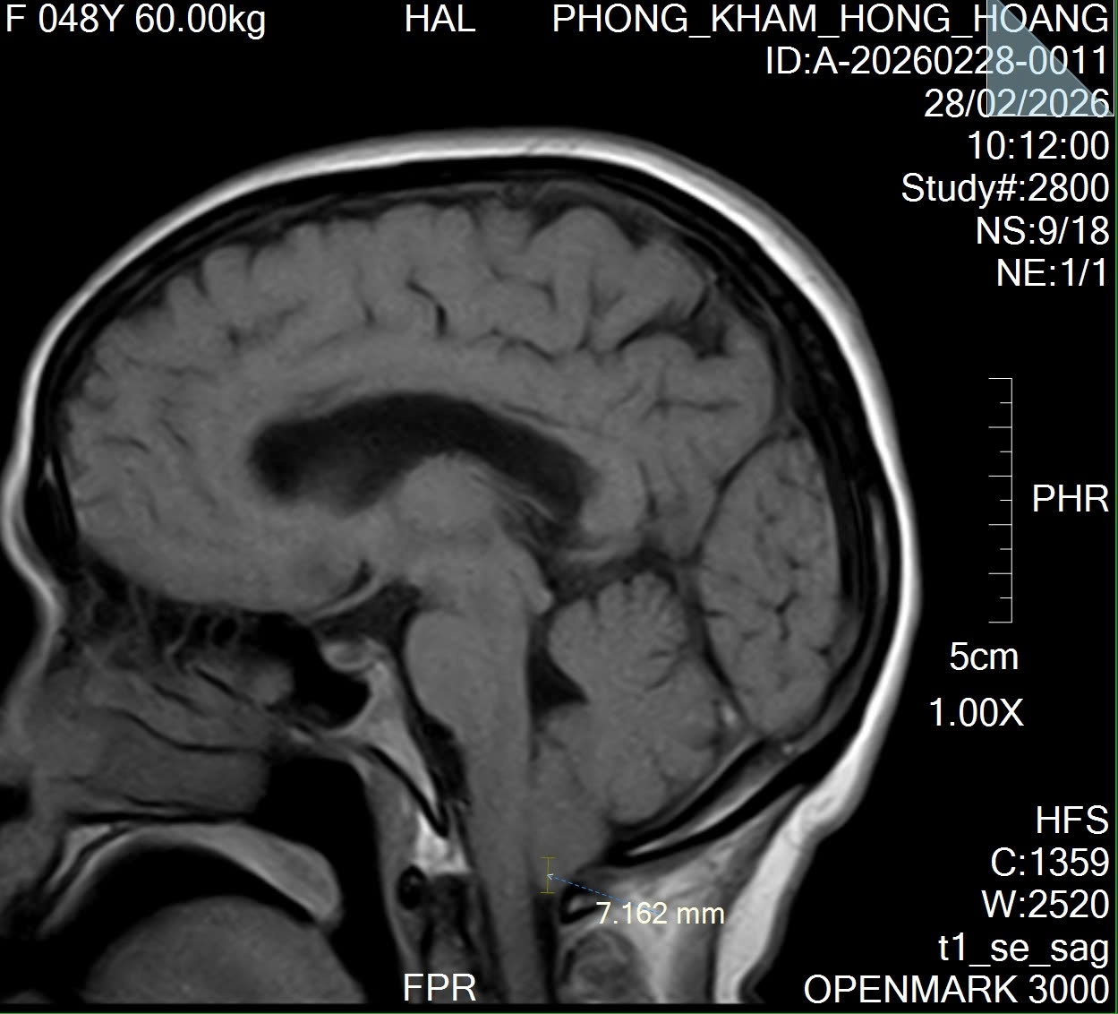 PHÁT HIỆN DỊ TẬT CHIARI NHỜ CHỤP CỘNG HƯỞNG TỪ SỌ NÃO (MRI)