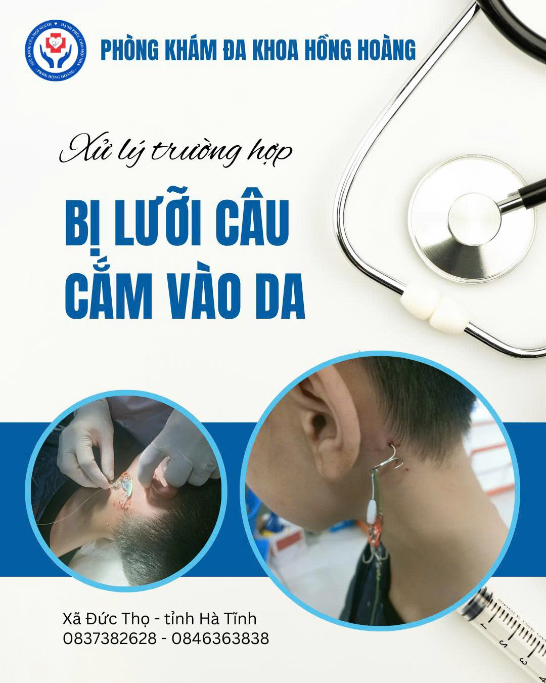 Tai nạn trong sinh hoạt - lưỡi câu cá mắc vào da