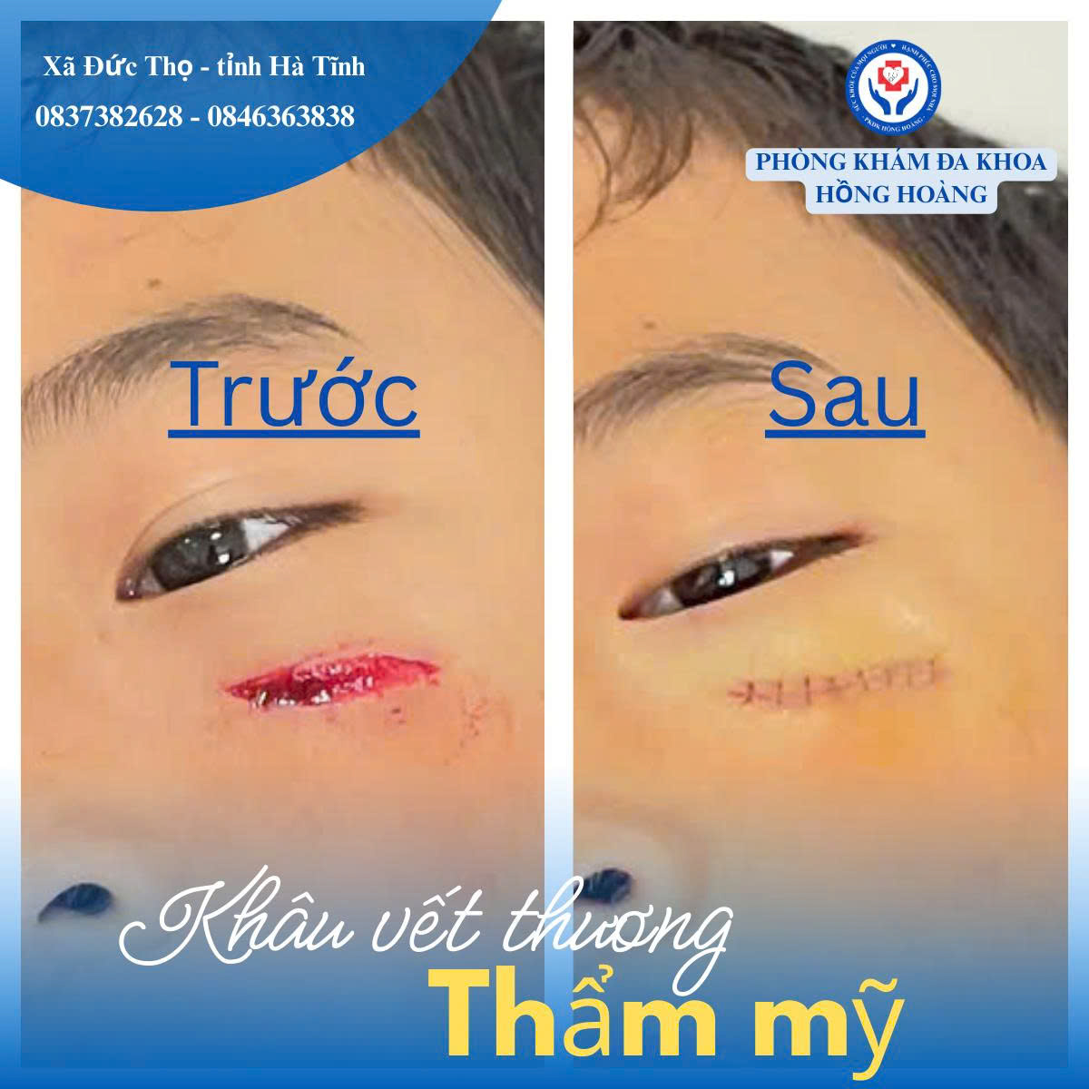 XỬ TRÍ KHÂU VẾT THƯƠNG VÙNG MẶT – ĐẢM BẢO THẨM MỸ TẠI PHÒNG KHÁM ĐA KHOA HỒNG HOÀNG