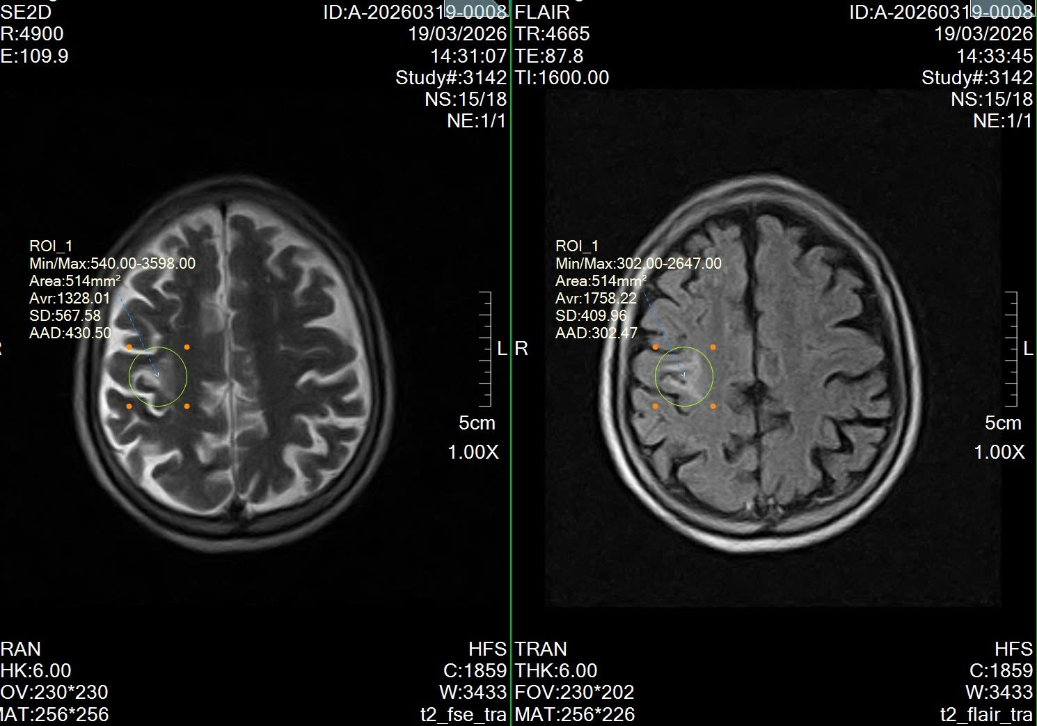 PHÁT HIỆN NHỒI MÁU NÃO QUA CHỤP CỘNG HƯỞNG TỪ MRI SỌ NÃO TẠI PHÒNG KHÁM ĐA KHOA HỒNG HOÀNG