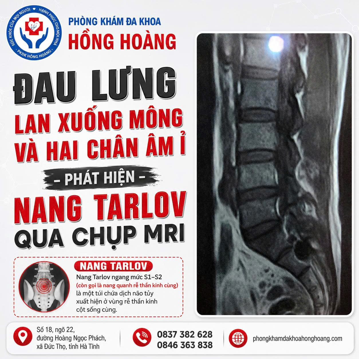 ĐAU LƯNG LAN XUỐNG MÔNG VÀ HAI CHÂN ÂM Ỉ – PHÁT HIỆN NANG TARLOV QUA CHỤP MRI