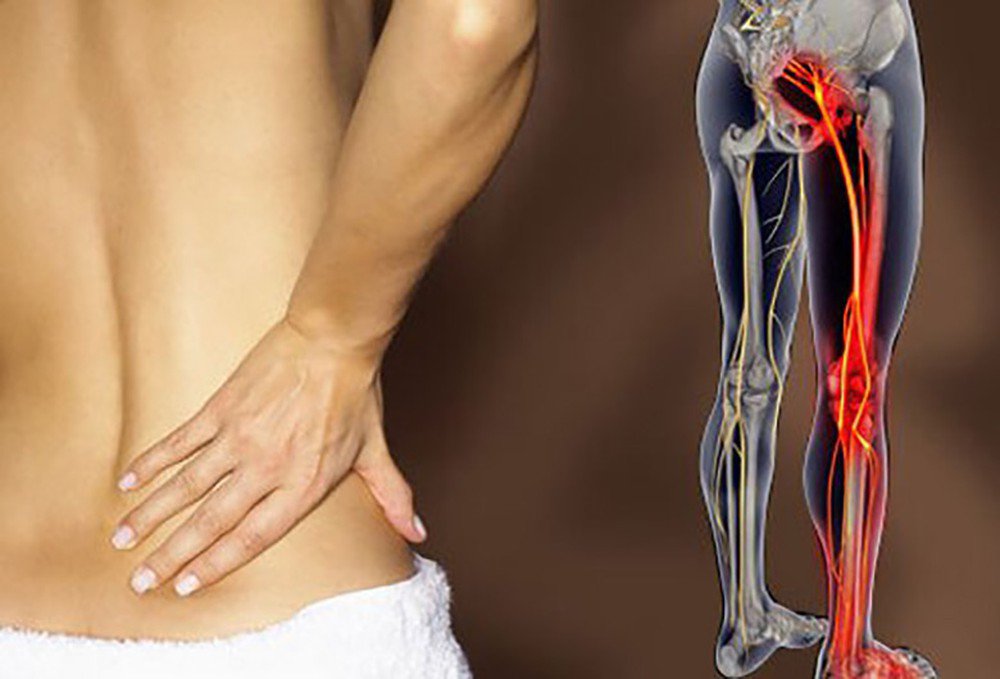 Cách phòng bệnh đau dây thần kinh tọa ở người trẻ tuổi