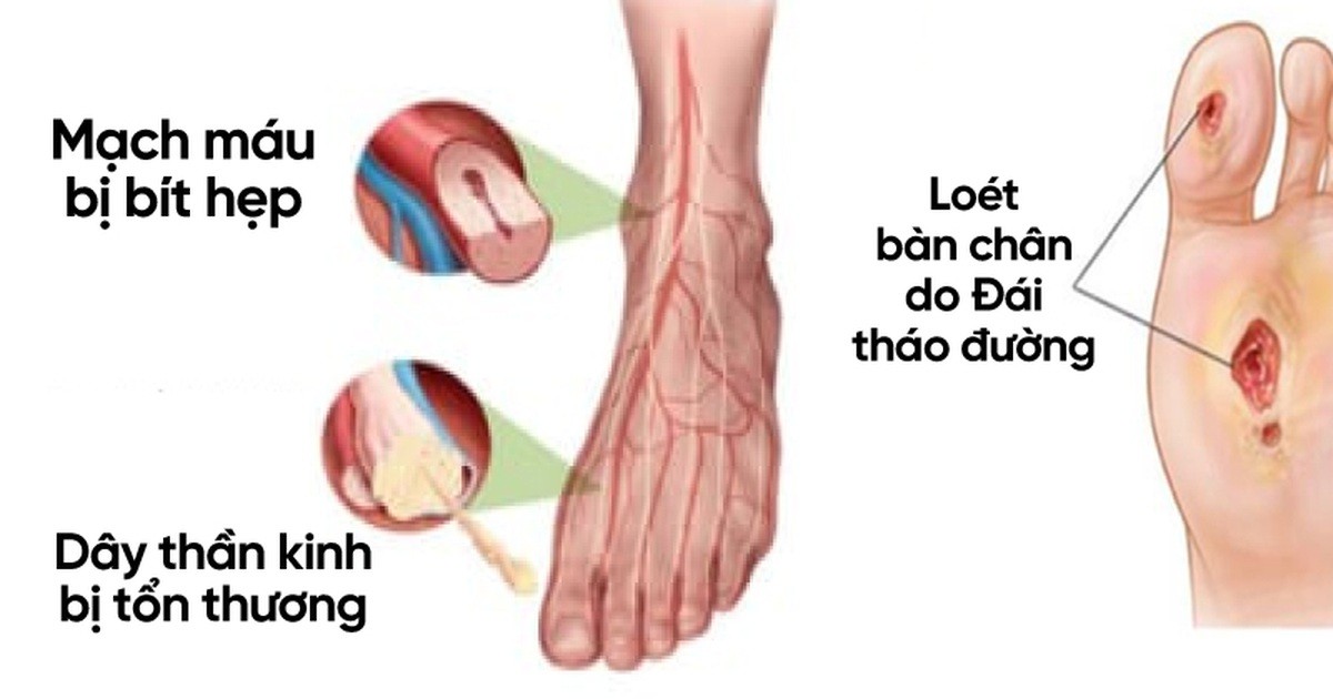 Nguy Cơ Tiềm Ẩn Khi Bị Đái Tháo Đường