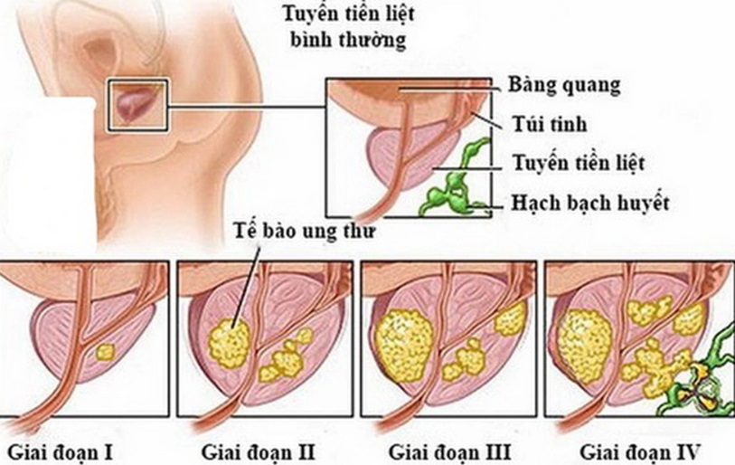 Cách Giảm Thiểu Nguy Cơ Phì Đại Tuyến Tiền Liệt Qua Bài Tập Thể Dục