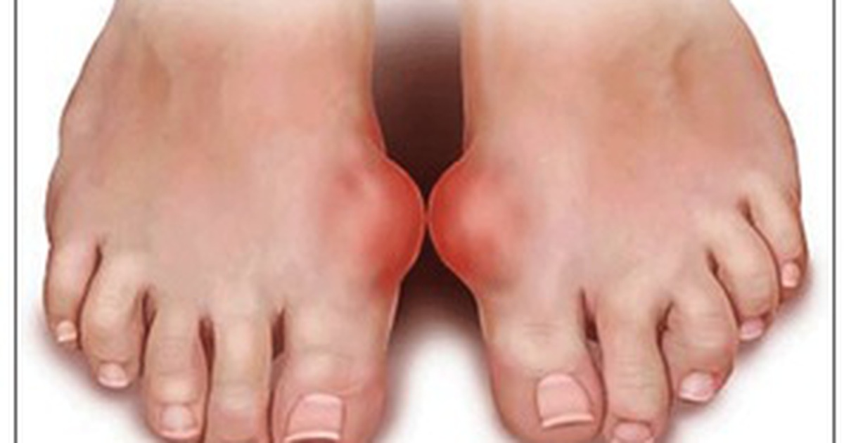Bệnh gout: Biến chứng và cách phòng ngừa