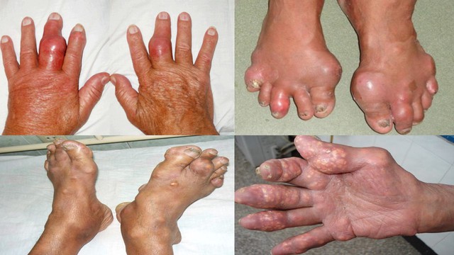 Nguyên nhân, triệu chứng và cách điều trị bệnh Gout