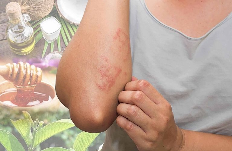 Mẹo hỗ trợ kiểm soát viêm da cơ địa tại nhà