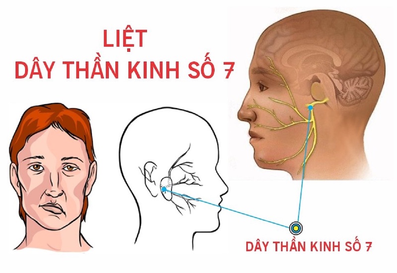 Những phương pháp phục hồi chức năng hiệu quả sau liệt