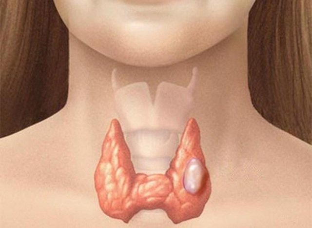 Bệnh nhân giáp(giáp nhân), những dấu hiệu cơ bản của nhân giáp cần lưu ý
