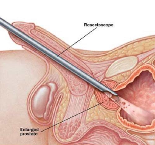 Một số Nguyên Nhân Gây Phì Đại Tuyến Tiền Liệt