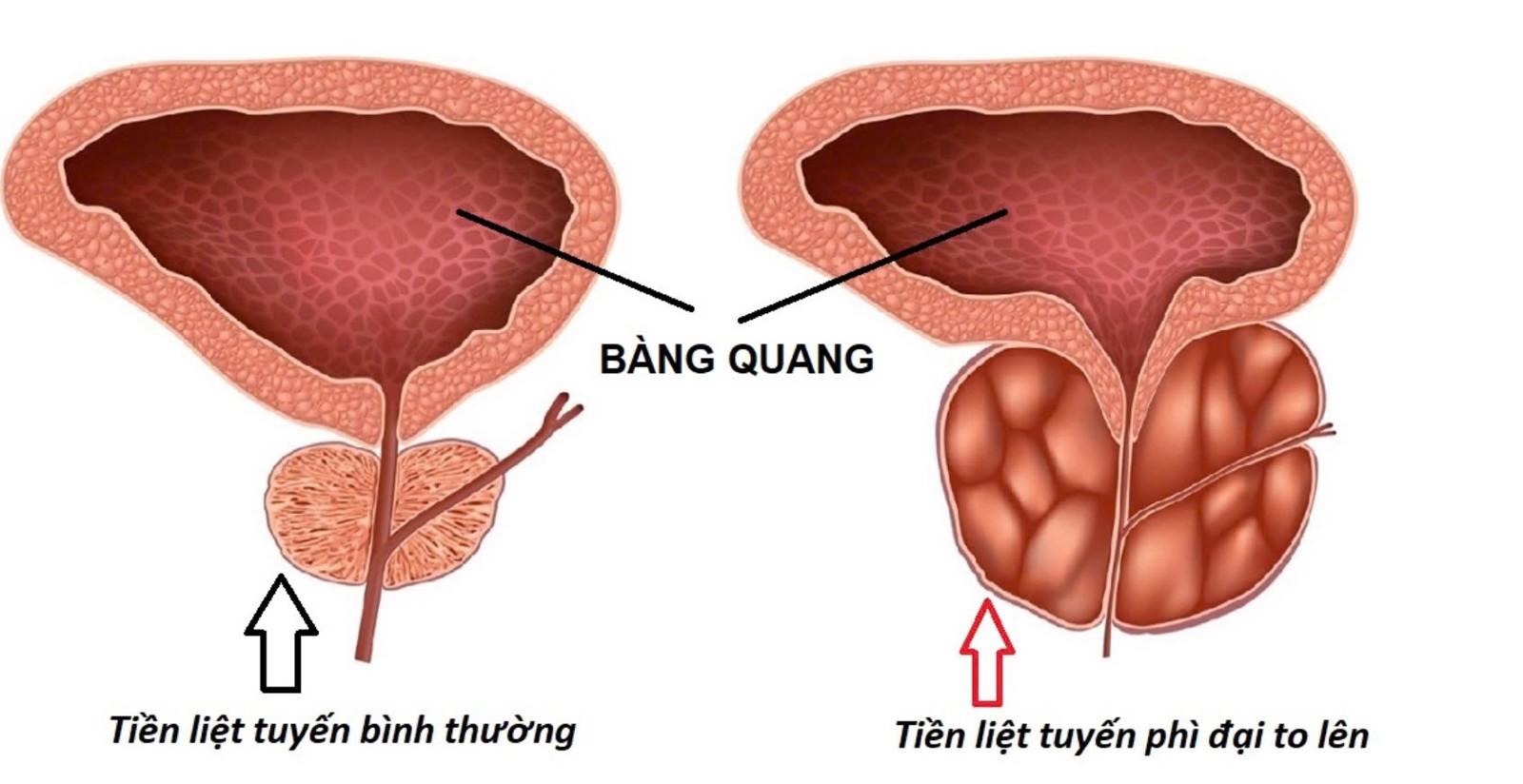 Bệnh Phì Đại Tuyến Tiền Liệt: Triệu Chứng Cần Lưu Ý
