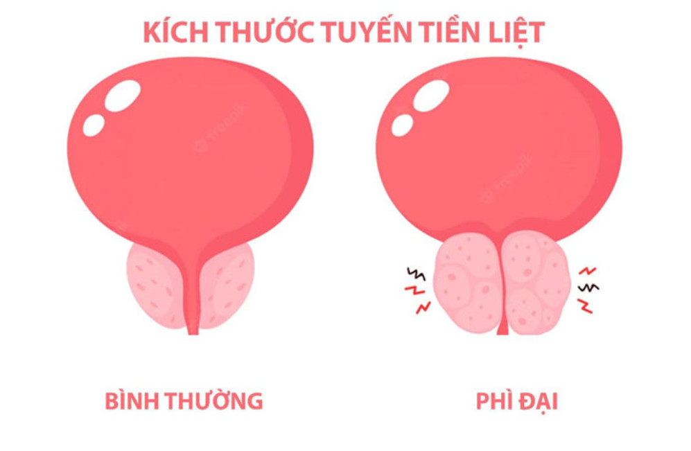 Biểu Hiện Của Bệnh Phì Đại Tuyến Tiền Liệt