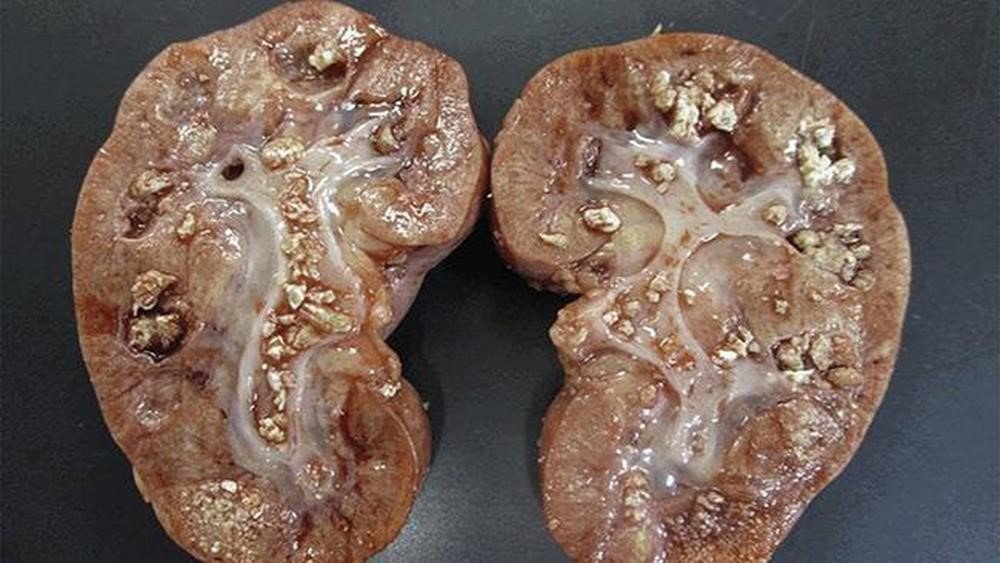 Nguyên nhân, dấu hiệu và Cách điều trị bệnh sỏi thận